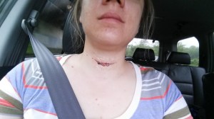 going home after surgery 